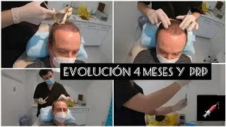 CONTROL EVOLUCIÓN 4 MESES + PRP !!!