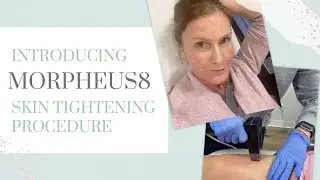 Introducing the Morpheus8 Skin Tightening Procedure! | Empowering Midlife Wellness