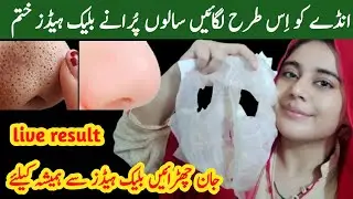 How To Remove BLACKHEADS Permanently From Nose & Face Instantly 💯| Naturally At Home | No Whiteheads