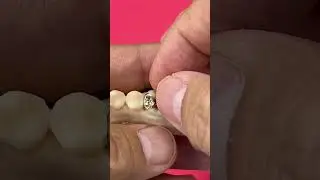 Gold Inlay/Onlays