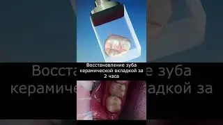 Как восстановить зуб за 2 часа - вкладка Cerec