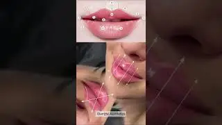 💋 Design the Perfect Lip Shape for Your Patients! 💋#lipinjections