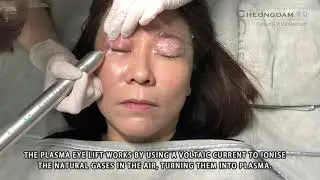 Plasma Eye Lift - Get your eyelid lift without PAIN& SURGERY !