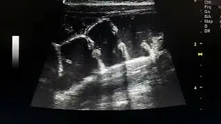 ultrasound appearance of dilated ascending colon