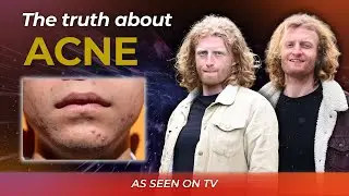 How to get rid of Acne? | Episode #24