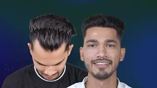 Hair Transplant In Pune || 🌟✨From thinning to thriving with the best hairline result! 💇&zwj;♂️✨