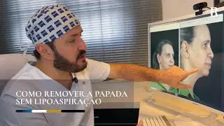 COMO REMOVER A PAPADA SEM LIPOASPIRAÇÃO | PELE MADURA | Dr. Rafael Evaristo