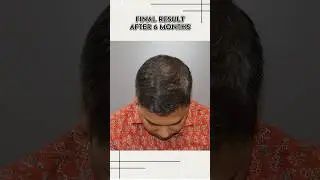 6 months to a fuller head of hair