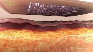 Morpheus8 Body Burst Animation