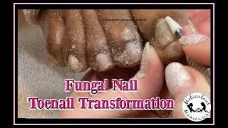Pedicure Tutorial: Thick Fungal Toenail Transformation