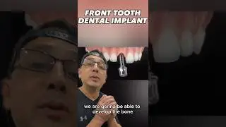 Dentist Explains Why the Dental Implant Process takes SO LONG | View Mobile Dental #shorts