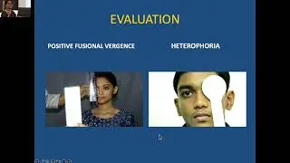 KSOS 2025  IC44  T Dr SANITHA SATHYAN  BINOCULAR VISION ANOMALIES IN KIDS