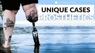 Custom Van Nes Rotationplasty Prosthetic Legs