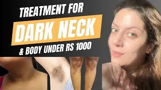 Treatment for dark neck, dark underarms, dark knees knuckles & pigmentation | गर्दन के कालेपन |