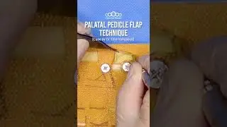 Техника небного лоскута на ножке #шорты
