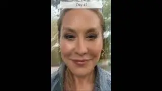 Dr De Silva&rsquo;s Vertical Face Restore 7, VFR-7, Signature facelift & Neck, Day 0 to Day 45 Recovery