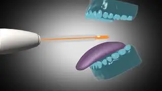 Cold Plasma for Tongue Disinfection | Breakthrough in Oral Hygiene Technology