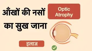 Treatment for optic nerve damage. The most common cause and treatment for permanent blindness.