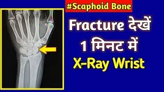 Fracture Scaphoid Bone // X-Ray Wrist // UdayXRay