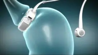 LAPBAND