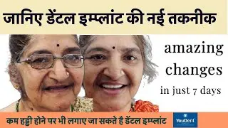 कम हड्डी होने पर भी लगाए जा सकते है डेंटल इम्प्लांट .YOUDENT HOSPITAL JAIPUR .BEST IMPLANT CENTRE