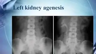 Intravenous Pyelography(IVP)