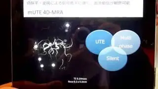 Vantage Galan 3T：  mUTE 4D-MRAを用いたMRA画像