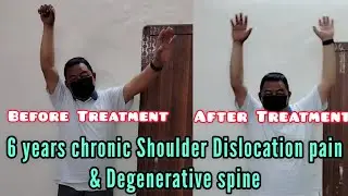 6yrs chronic Shoulder Dislocation pain & degeneration spine control different modified Chiropractic