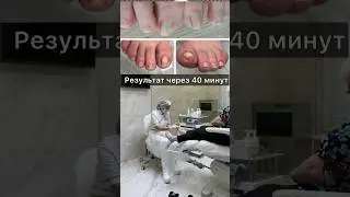 Консультация по ликвидации точки боли у пациента | #вросшийноготь  #подологтатьянапак #подногтем