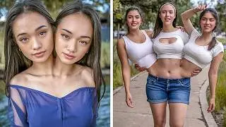 25 Conjoined Twins You Won't Believe Exist