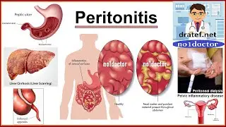 Waht is the peritonitis Acute Abdomen,/Appendicitis & Peritonitis/ General Surgery Lecture/Mrcs/Frcs