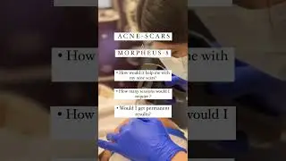 Got Acne Scars? Discover How Morpheus-8 Can Help! ✨