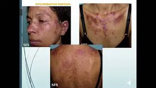 Dermatolog&iacute;a, MEDUVSF 2025: Mesenquimopat&iacute;as Autoinmunes