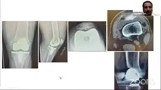 «Знай свой пластик» при замене коленного сустава