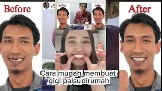 CARA MEMBUAT GIGI PALSU VENEER GIGI SNAP ON SMILE