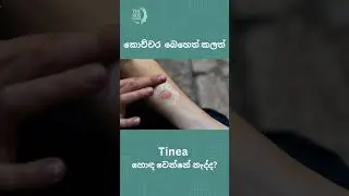 Tinea Infection on Skin in Sinhala | Dr Nayani Madarasinghe