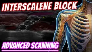 Interscalene block - ADVANCED scanning