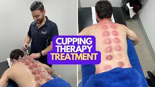 Back Cupping Therapy Treatment | Bankstown Physiotherapy