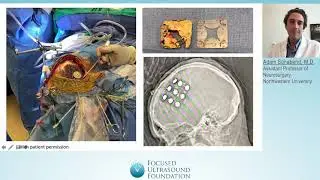 GBM Workshop 2021 &ndash; Clinical Trial of BBB Disruption with Implantable Ultrasound for Recurrent GBM