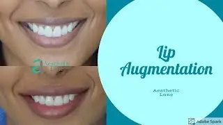 Lip Augmentation using Juvederm Vollure