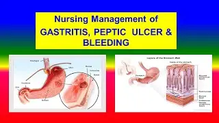 GASTRITIS , PEPTIC ULCER & BLEEDING  - Medical Surgical Nursing