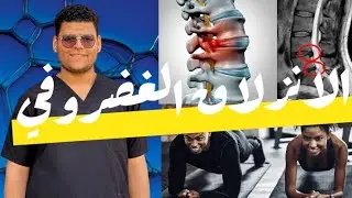 كل اللي محتاج تعرفه عن الانزلاق الغضروفي وأحسن تمارين تخفف الألم#الانزلاق_الغضروفي#علاج_طبيعي