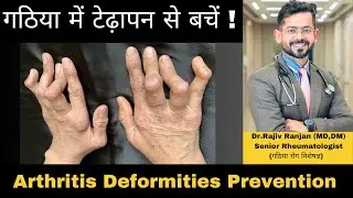 गठिया में टेढ़ापन से कैसे बचे ? | Arthritis Deformities Prevention | Rheumatoid Arthritis