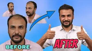 Hair Transplant With Natural Hair Line - Amazing Hair Growth After Hair Transplant| hair transplant