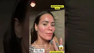 Microagulhamento Facial. Estimulando o rejuvenescimento facial.