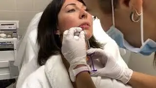 Коррекция губ juvederm volift | Косметология dl.forma