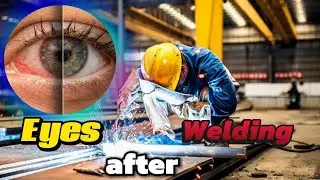 Welding Flash/Arc Eye Treatment at Home | Aankhon mein welding lag jaye to kya karein?