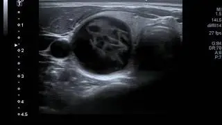 Colloidal node with hemorrhage