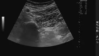 Anterior approach of Sciatic Nerve