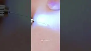 FIBROBLAST PLASMA PEN против ручки для удаления бородавок PLAXAR &mdash; какая из них лучше 👀